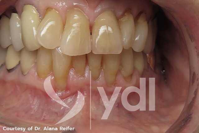 YDL Dental Lab Featured Case