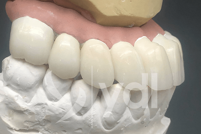 YDL Dental Lab Featured Case